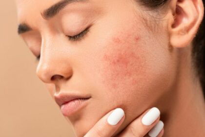 Skin Care If you want to get rid of facial boils and spots, then adopt these 5 home remedies, it will take effect immediately
