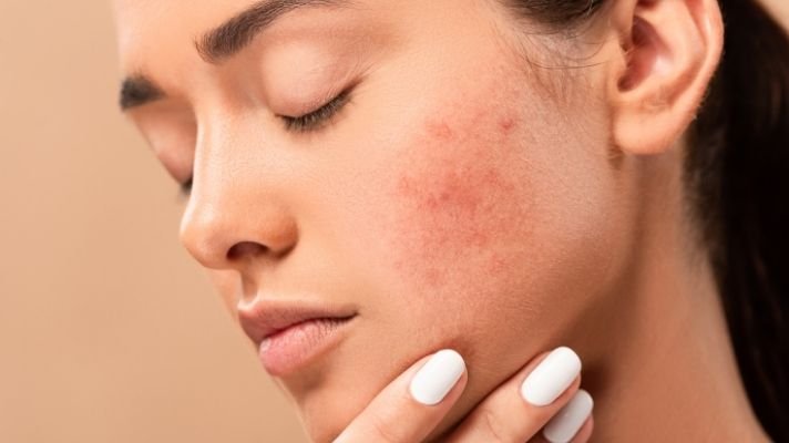 Skin Care If you want to get rid of facial boils and spots, then adopt these 5 home remedies, it will take effect immediately