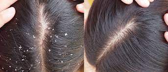 Get rid of dandruff in hair, know special ways