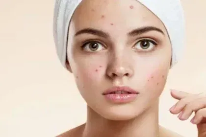 Apply multani mitti on the face like this, acne will disappear