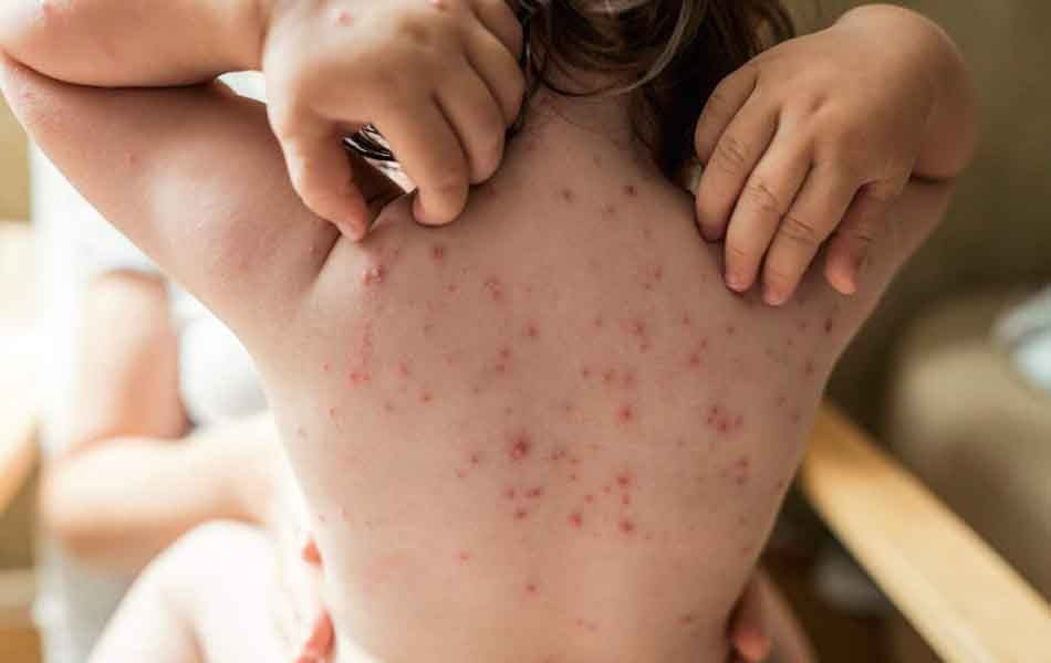 Measles-Rubella