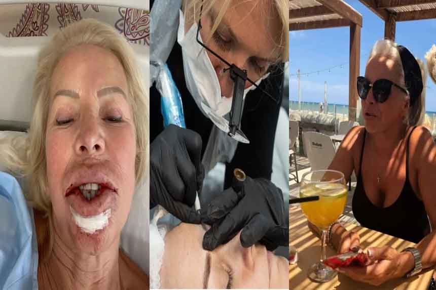 pauline-64-year-old-woman-got-lip-surgery-done