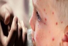 Nigeria Suspected Measles